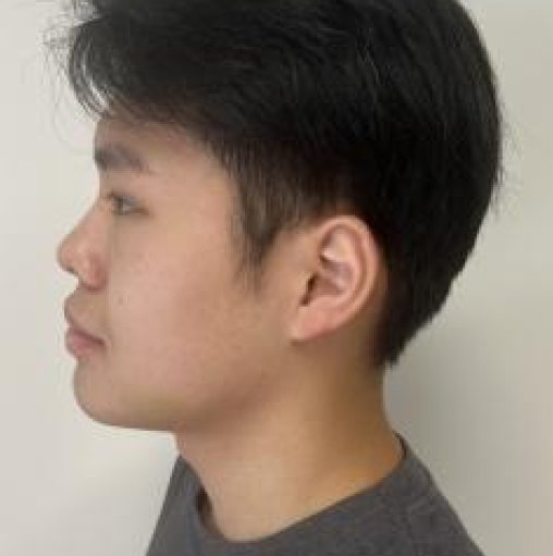 After Chin Surgery
