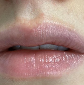 After Dermal Fillers