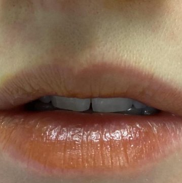 Before Dermal Fillers